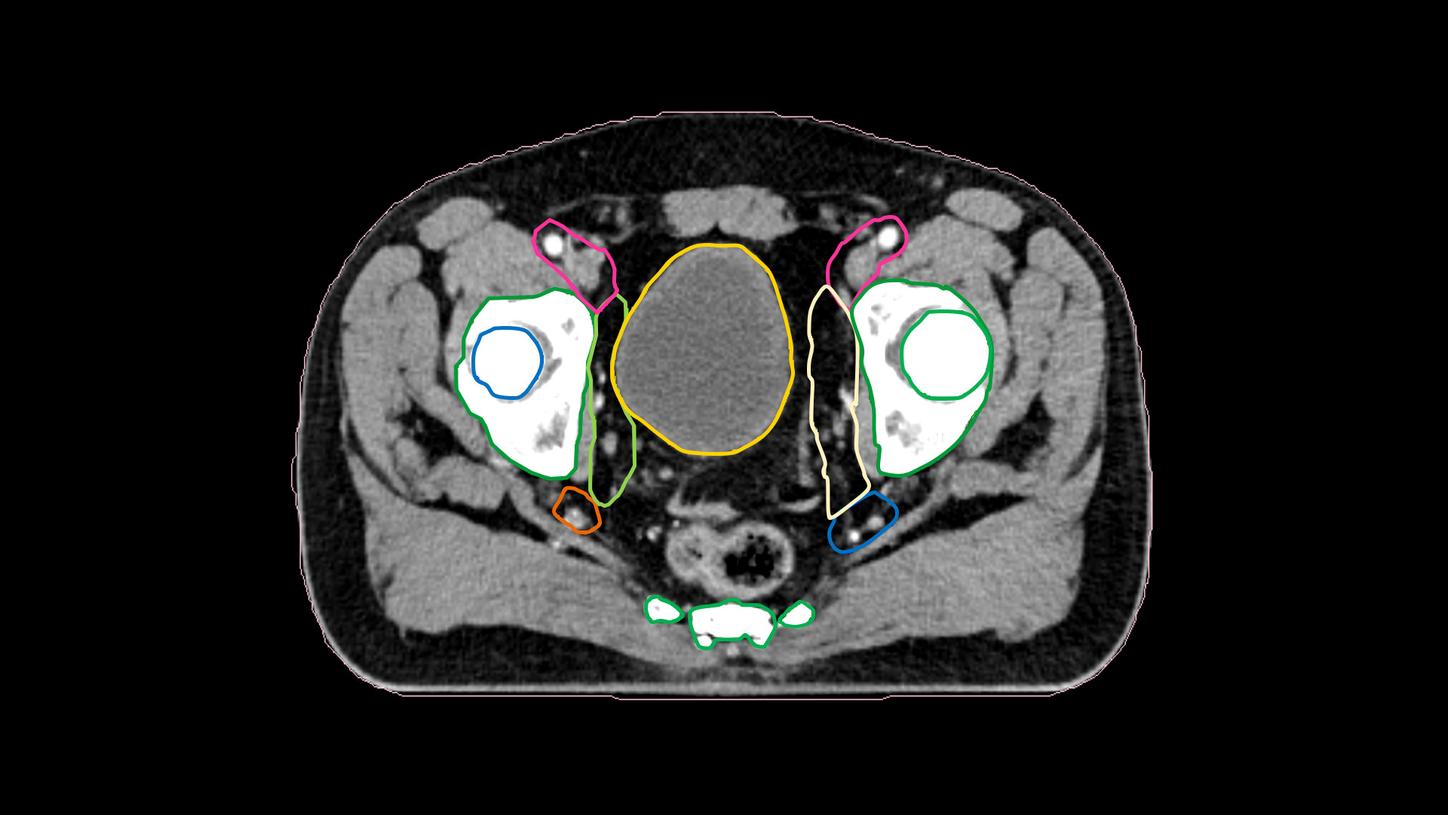 Deep-learning based autcontouring solutions 