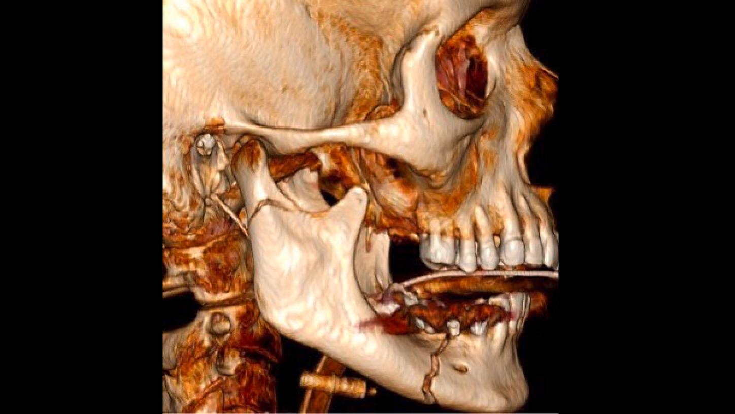 Fractura conminutiva panfacial compleja 04