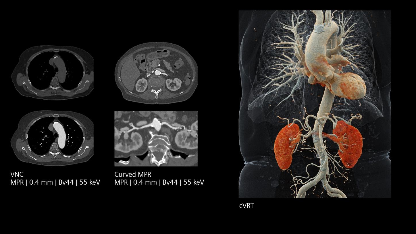 Axial and 3D CT images of chest, abdomen, and vasculature with kidneys highlighted in orange.