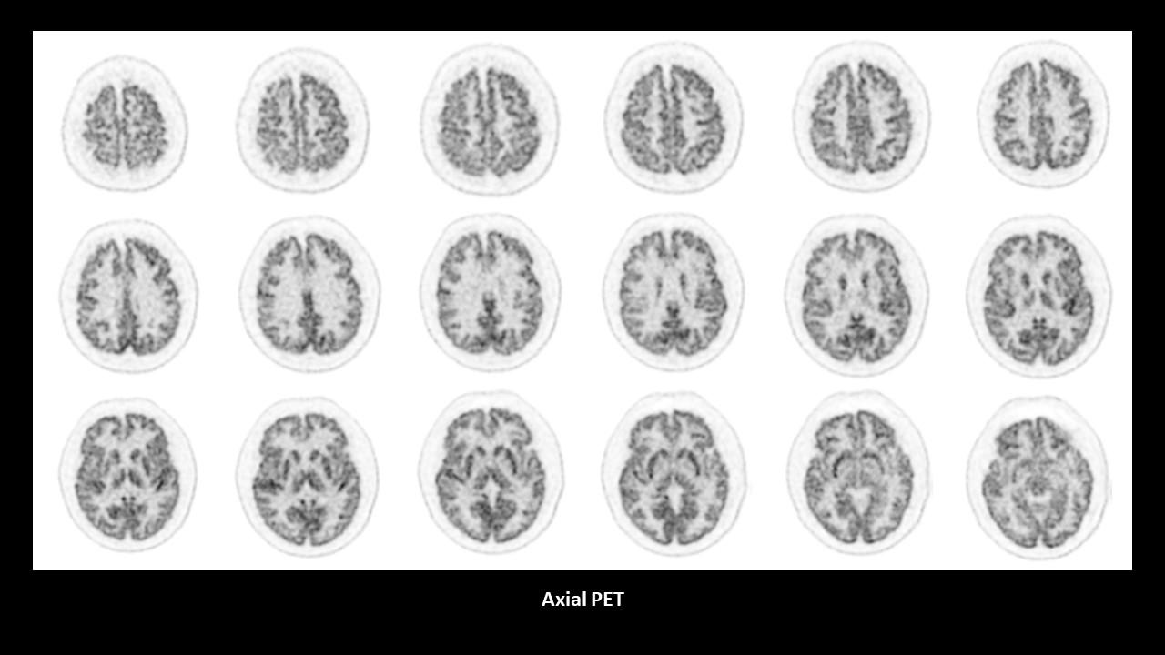 PET CT Biograph Trinion Neuroimaging