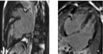 Fig. 3: CMR LGE images showing no myocardial fibrosis. (A) 2-chamber view and (B) 4-chamber view.