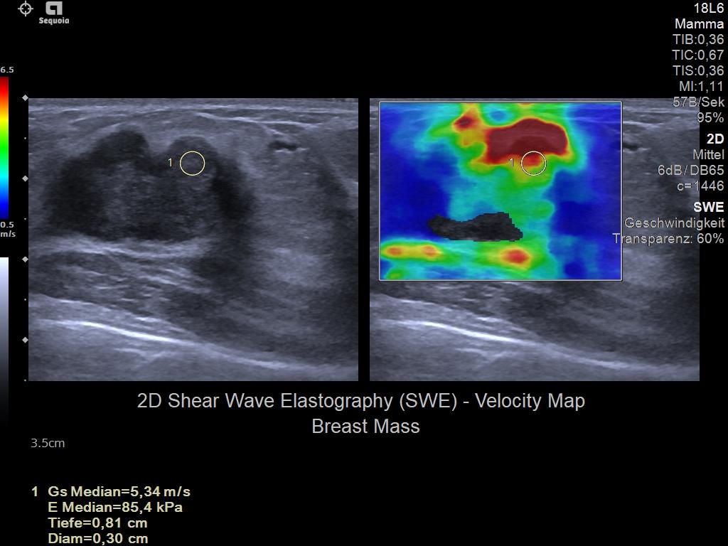 Elastography_2DSWE