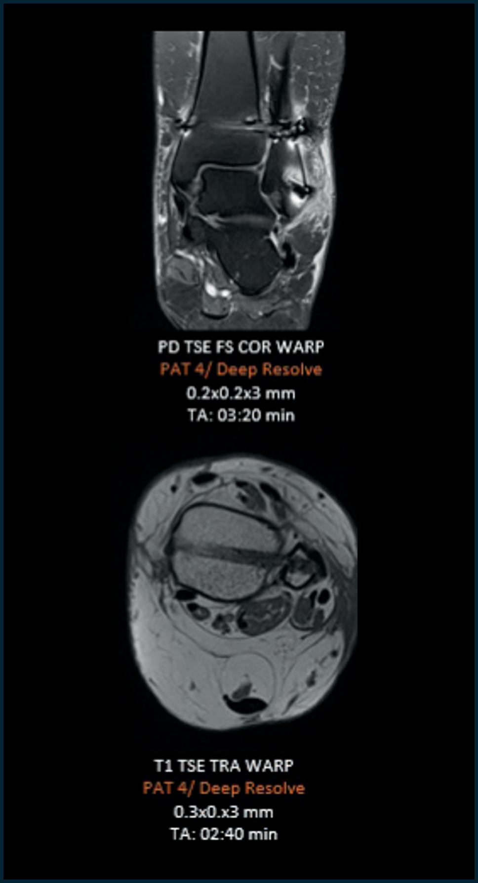 Deep resolve MRI_ankle_2