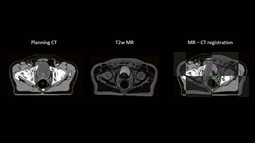MR-only Radiotherapy Planning - Siemens Healthineers