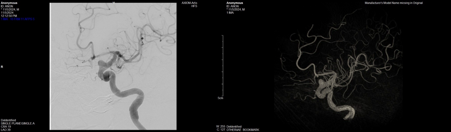 Fig A, B - Oblique initial angiogram and Dyna 3D showing left wide neck left internal carotid aneurysm