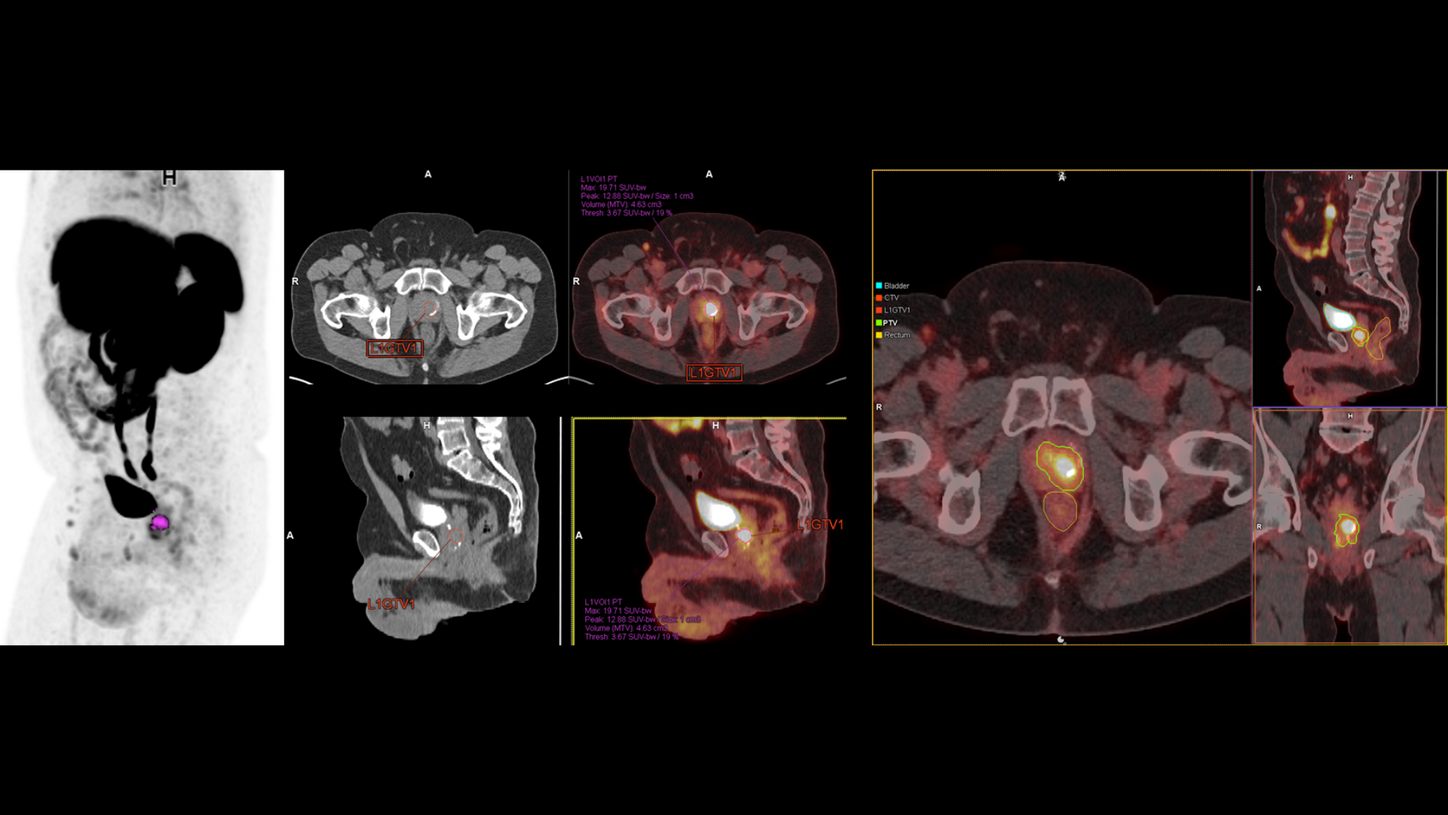 Rectal/Pelvic RT