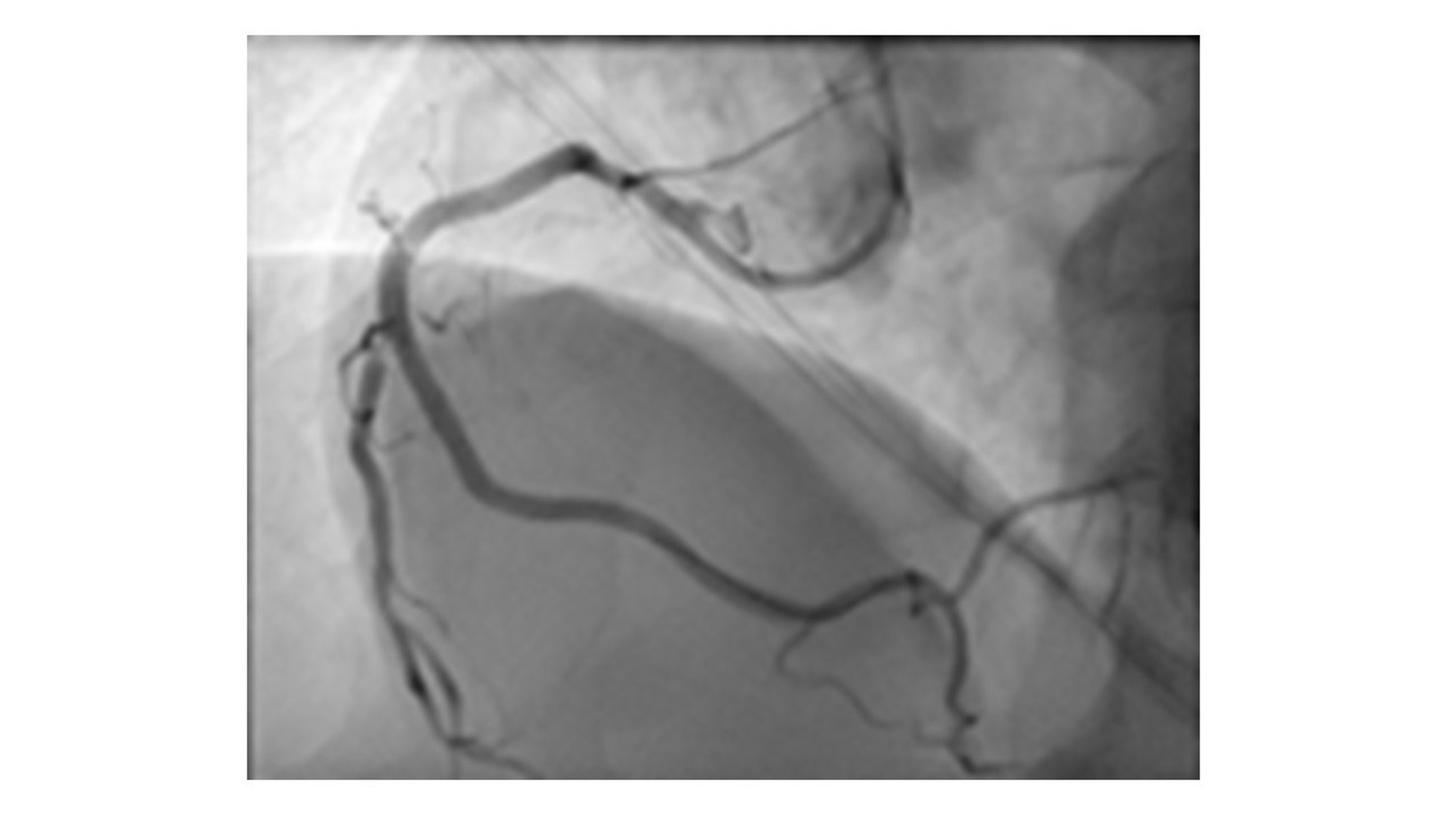 OPTIQ AI-based image denoising image