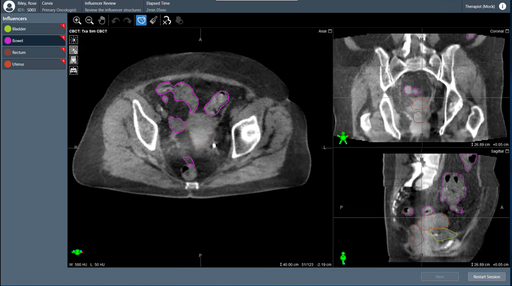 Ethos Radiothrapy Changing the way we think about radiation delivery