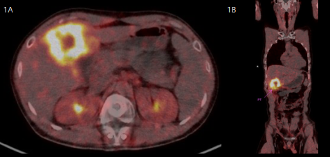 Fig 1A & 1B: Demonstrate axial & coronal view of the PET-CT which showcases hypermetabolic activity in hepatic segments IV/V.