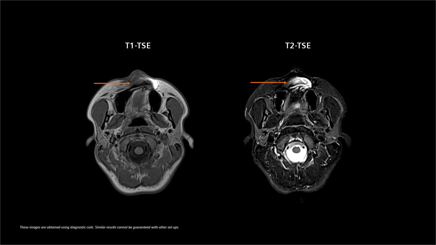 Low-field imaging reduces artifacts near metal implants