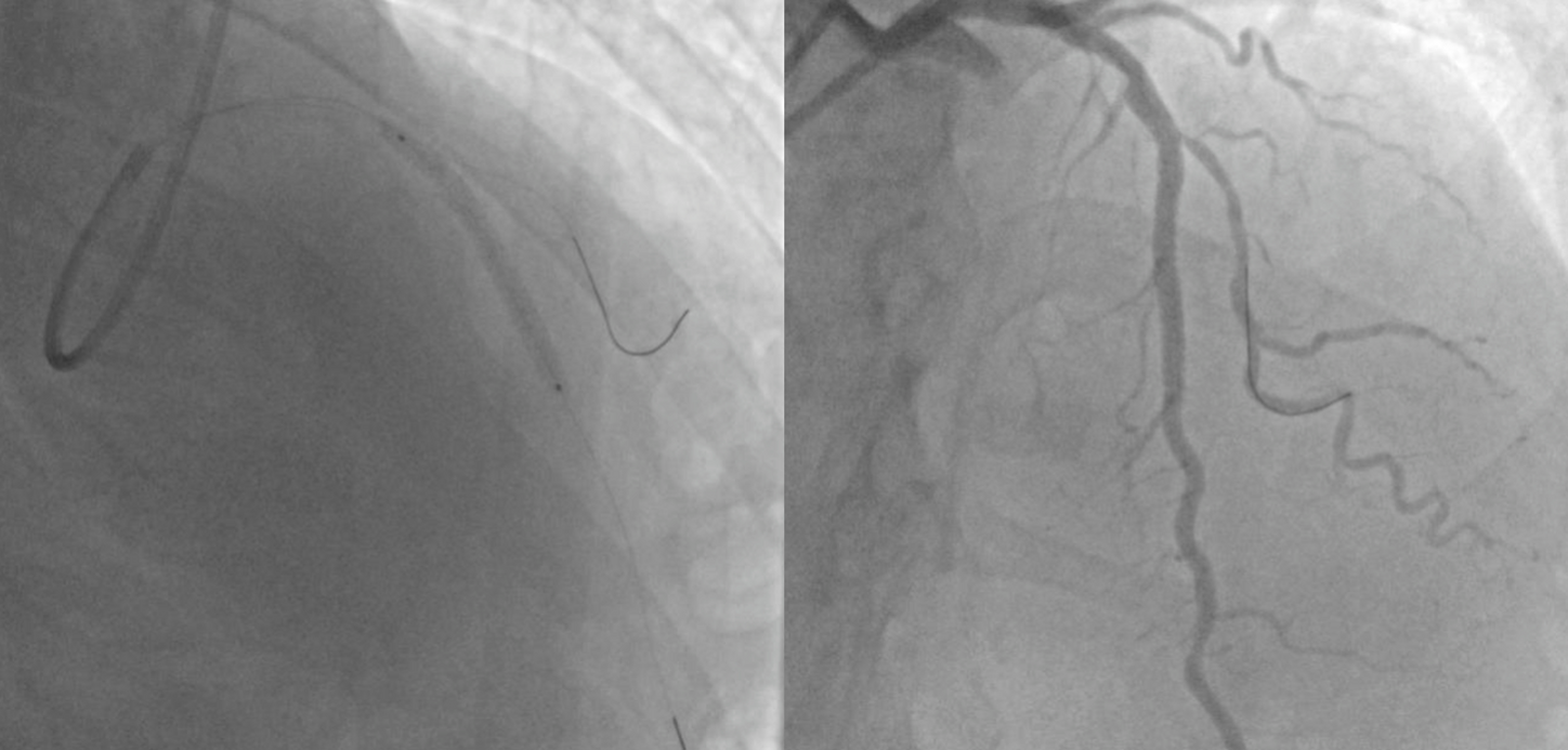 A coronary angiogram demonstrates successful total recanalization of the left anterior descending (LAD) artery following percutaneous coronary intervention (PCI) and the deployment of a drug-eluting stent.
