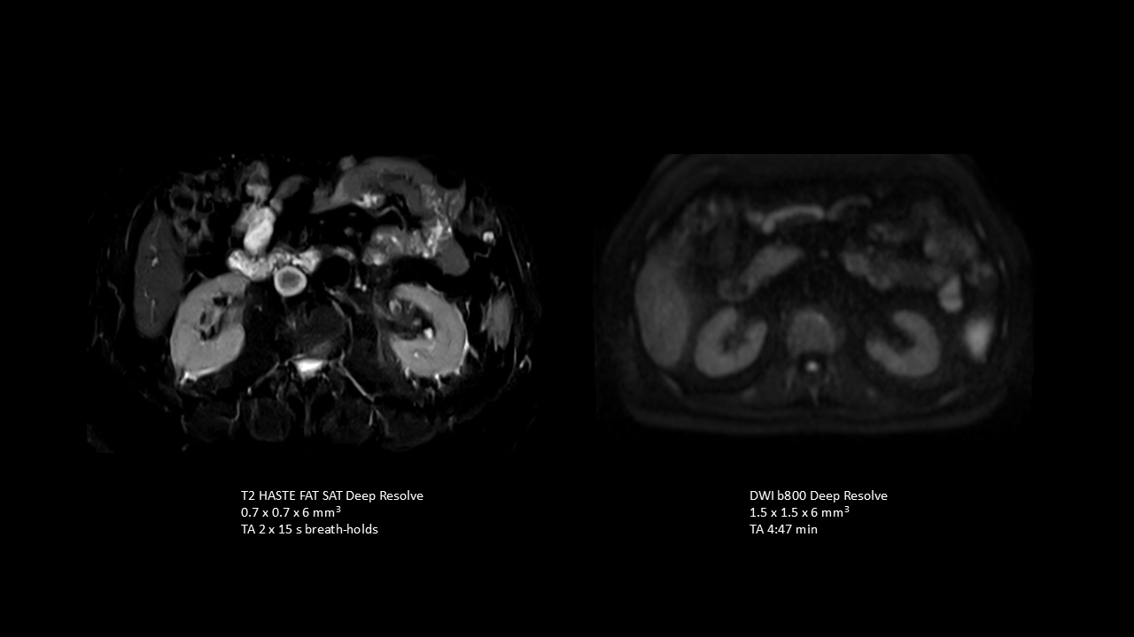 T2 HASTE and DWI in renal imaging