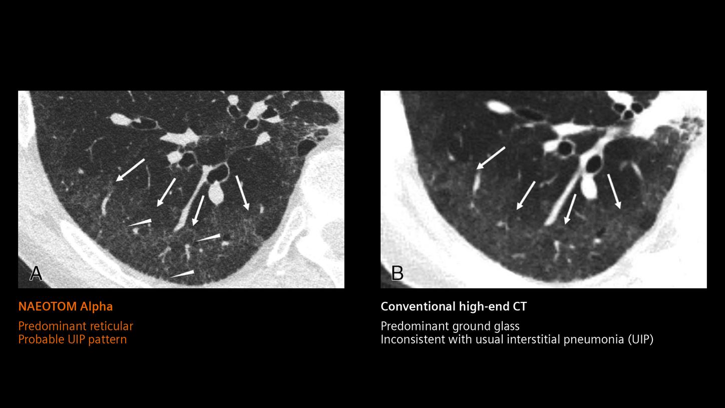 Comparison of a clinical image of a lung acquired with a conventional CT and one acquired with a photon-counting CT.