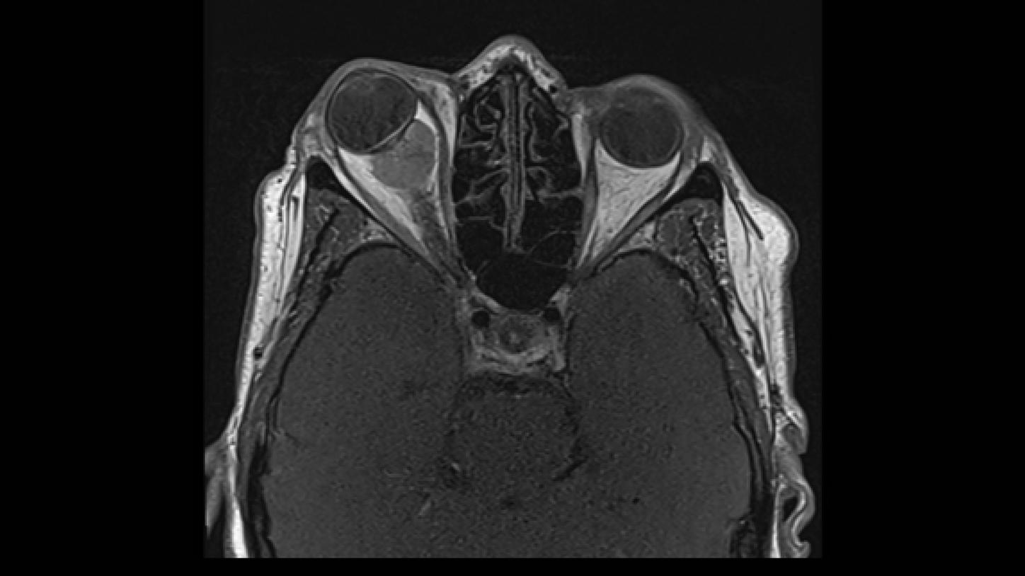 meningioma óptico