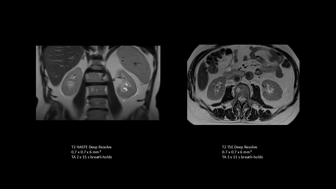 T2 and diffusion-weighted imaging for renal pathology   