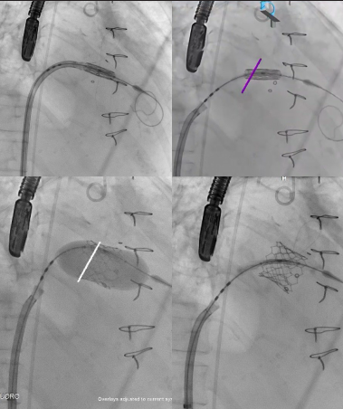 Valve positioning and deployment under fusion guidance.