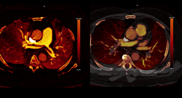 Photon-counting CT scan of pulmonary embolism showcasing multiplanar spectral images, including axial, coronal, and sagittal views with monochromatic reconstructions at different keV levels. The images are represented as Virtual Non-Contrast (VNC), iodine map, mixed iodine and grayscale, lung vessel separation, lung volume, and lung PBV (perfusion blood volume) functional lung data, providing a comprehensive visualization of anatomical and functional details essential for diagnosing and evaluating pulmonary embolism.
