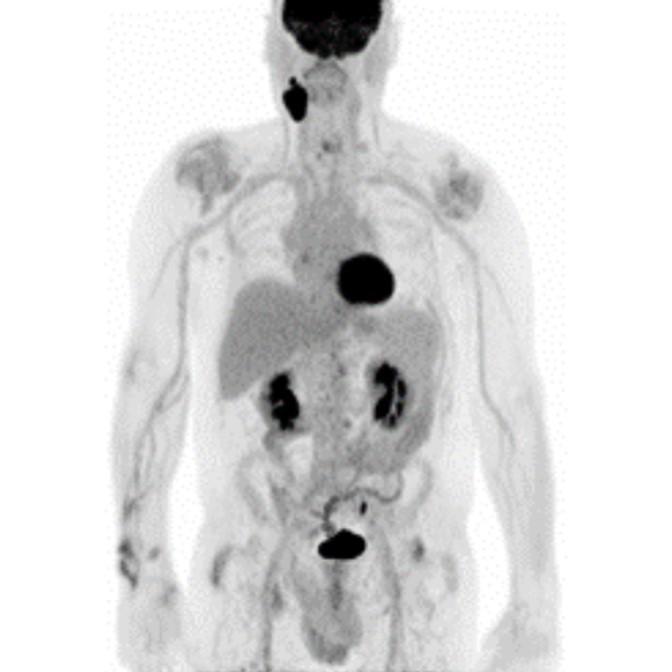 Oncology Indications Head an Neck