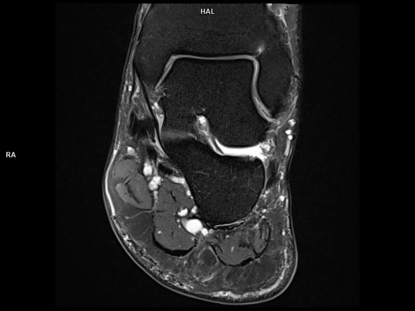 Coronal PD FS-MAGNETOM Lumina