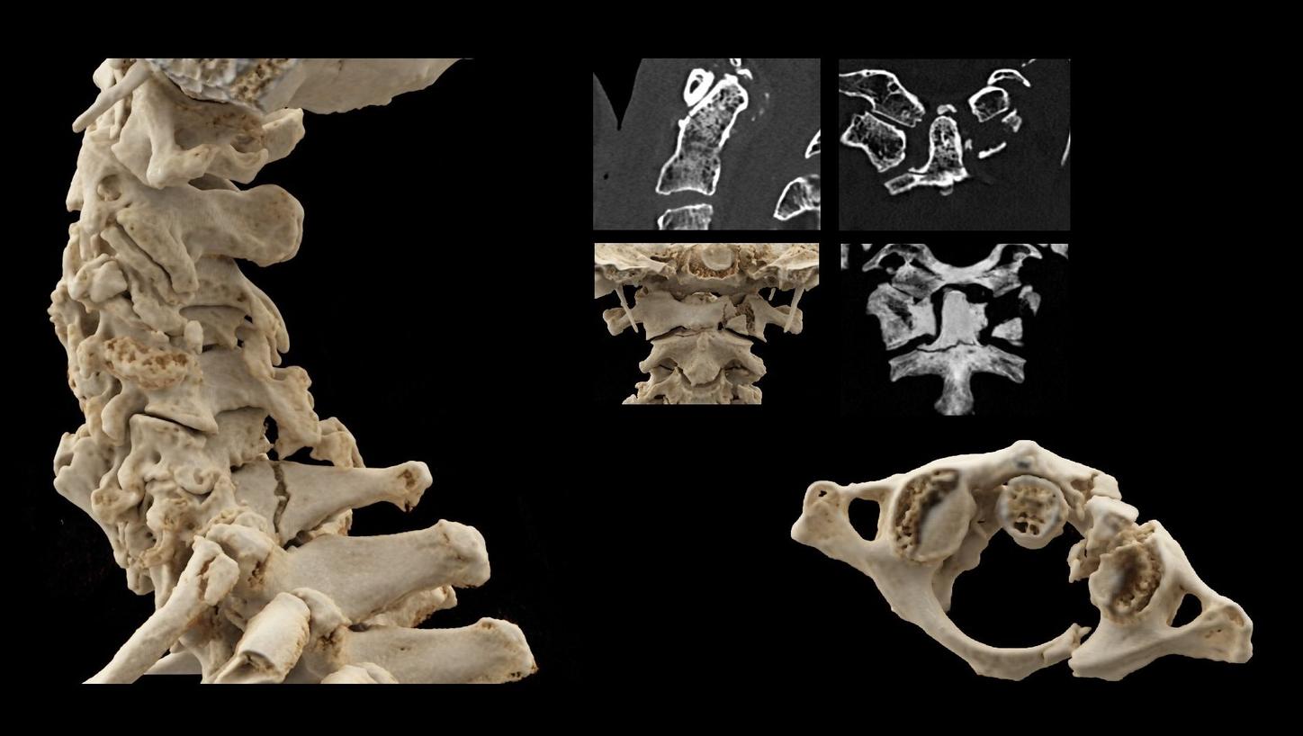 A dens fracture - invisble to visble 