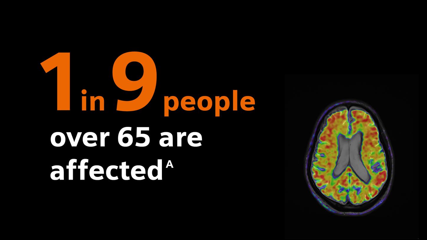 Infographic stating “1 in 9 people over 65 are affected,” alongside a colorful brain scan image.