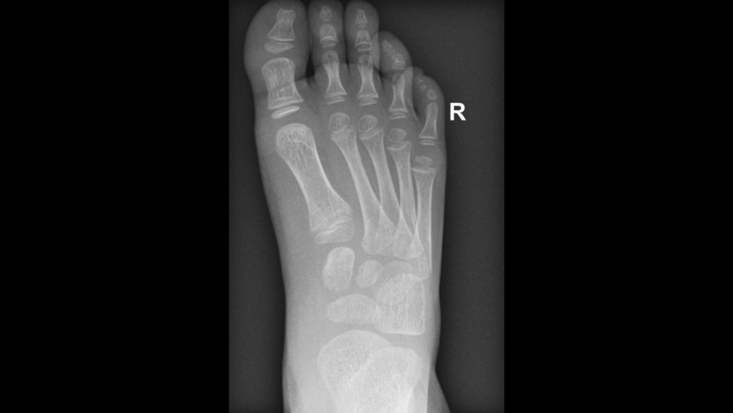 DI XP QNAMIX Foot Pediatric