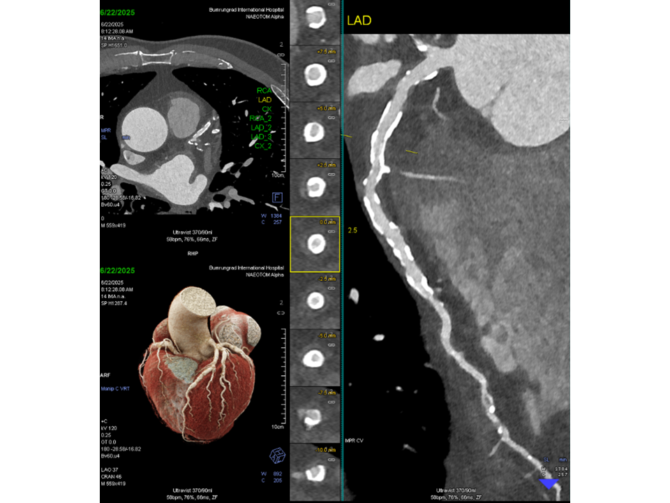 Axial and cVRT images from CCTA courtesy of Bumrungrad International Hospital, Bangkok, Thailand