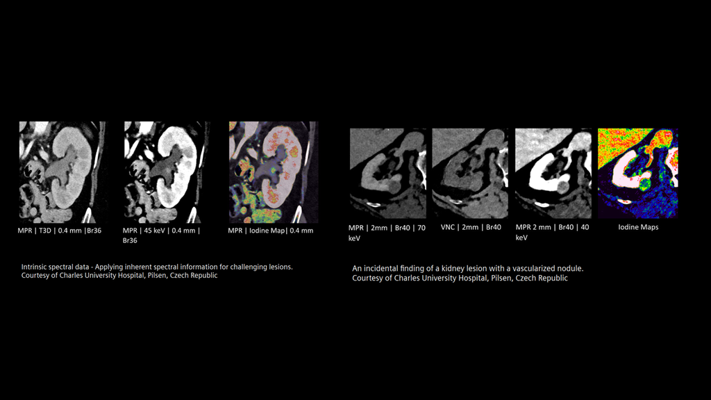 NAEOTOM Alpha Photon-counting CT Clinical Update