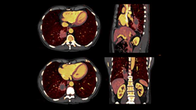 NAEOTOM Alpha.Prime for RT CT Clinical image