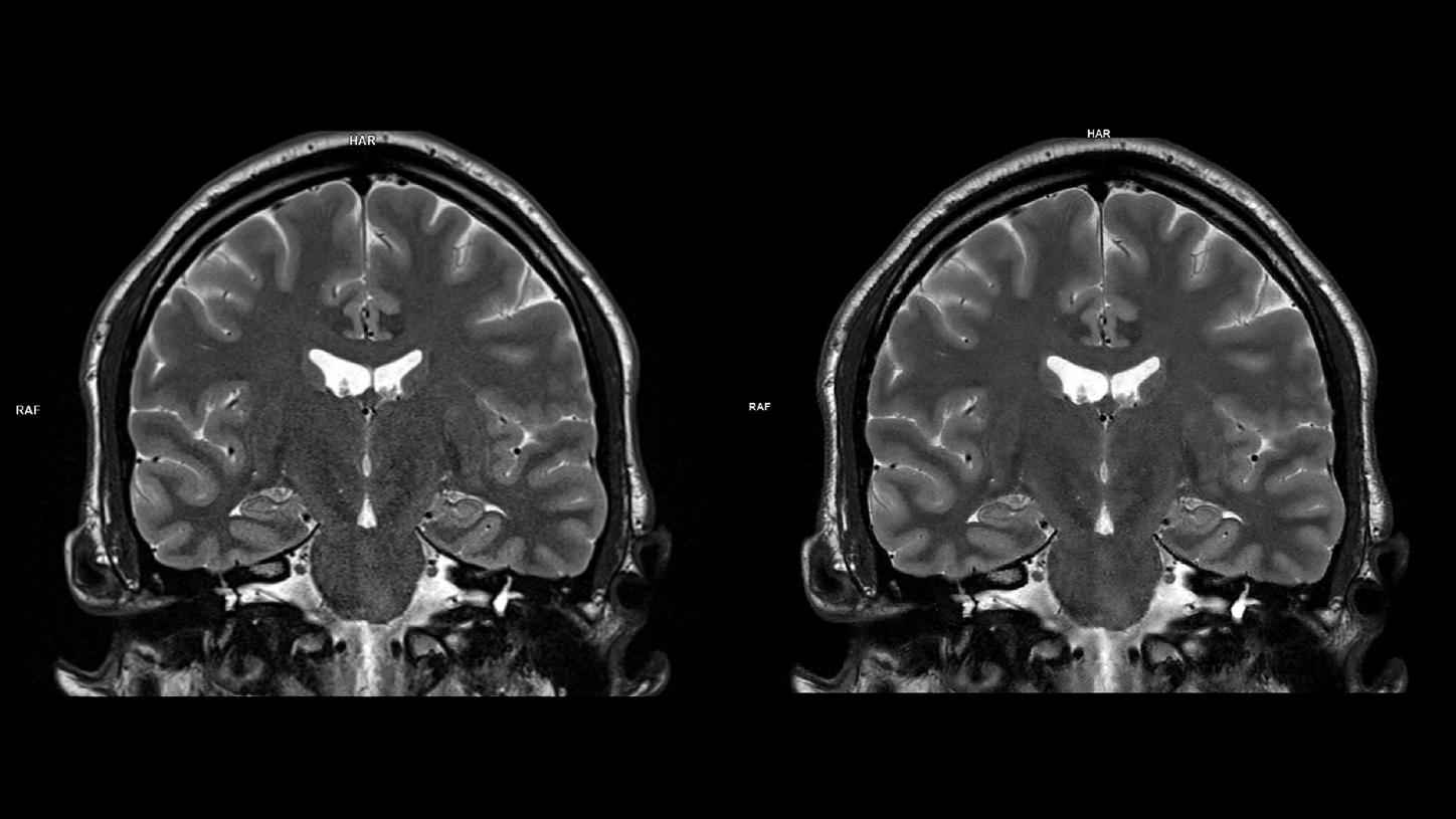 Coronal T2 DR Sharp-MAGNETOM Lumina/Coil-HeadNeck 20/Resolution-1024/Scan Time-2:05/Aceleration-p2