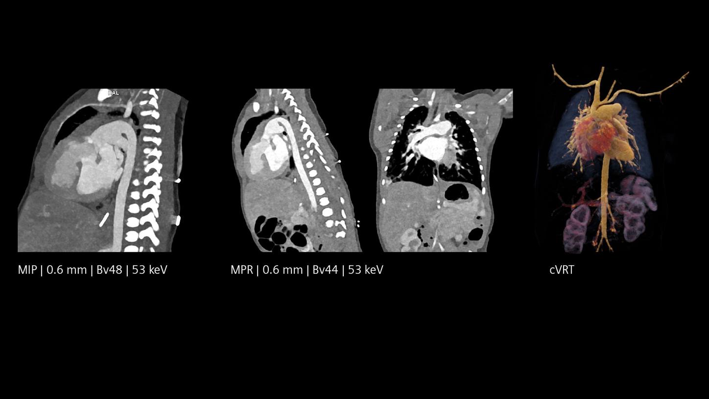 Low-dose pediatric CT imaging with intrinsic spectral information of a pediatric truncus arteriosus communis with high detail.