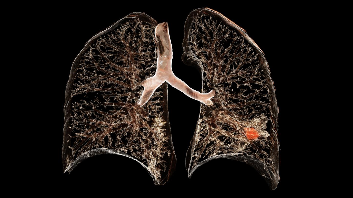 Lung Cancer