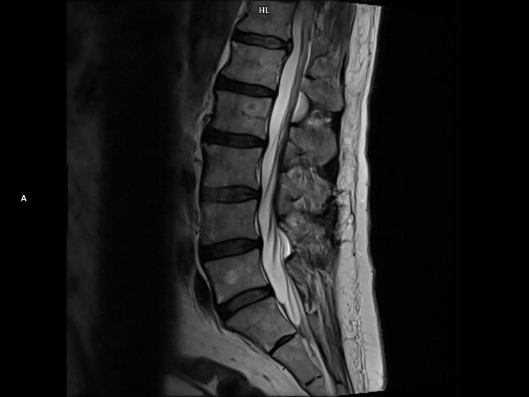 Sagittal T2-MAGNETOM Lumina/Coil-Spine 24/Resolution-384/Scan Time-1:45