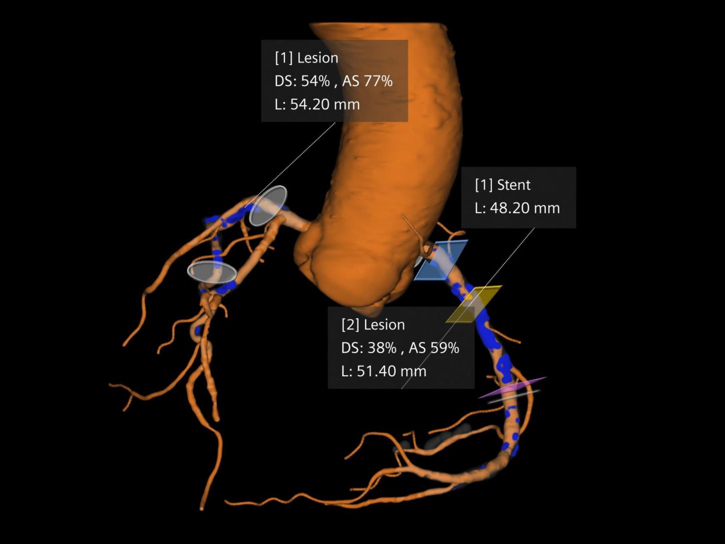 ct coronary cockpit best in class