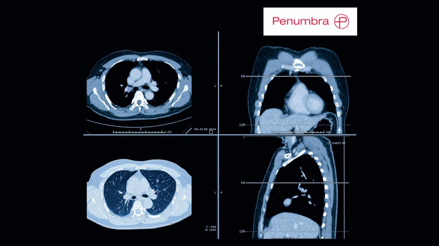 Zatorowość płucna-Penumbra