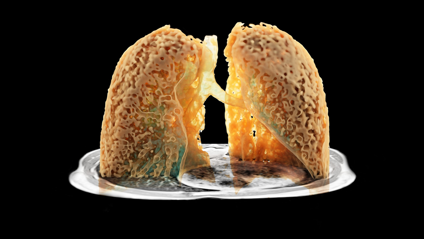 MR Pulmonary MRI