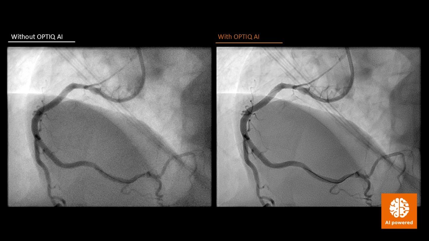 Side-by-side X-ray images comparing standard imaging versus AI-powered OPTIQ technology. Demonstrates improved image clarity, reduced noise, and optimized radiation dose for cardiovascular procedures using advanced AI algorithms.