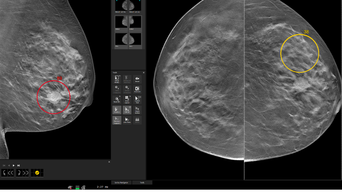 MAMMOVISTA B.smart mit evidenz-basierten Next-gen AI<sup>2</sup> Optionen mit interaktiver Entscheidungshilfe für effiziente Befundung.