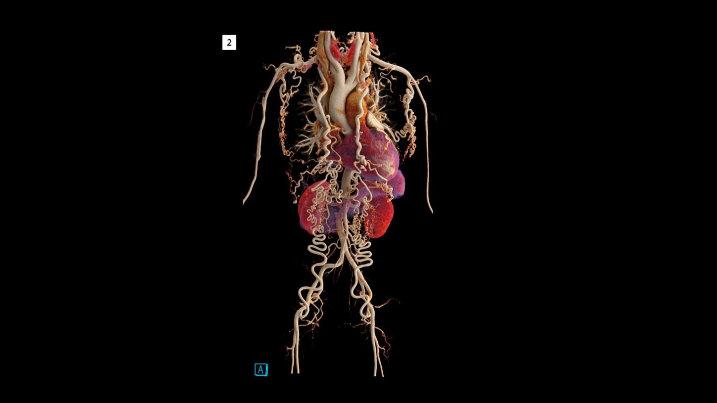 A cVRT image shows an overview with abundant collaterals, formed by bilateral enlarged internal thoracic arteries, superior and inferior epigastric arteries, as well as dilated branches of bilateral subclavian arteries.