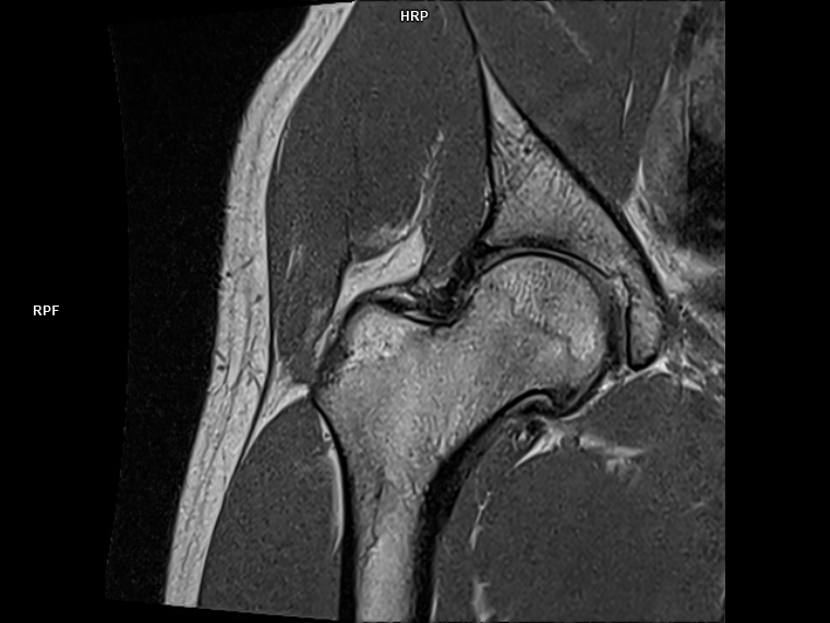 Coronal T1-MAGNETOM Free.Max/Coil-Contour Small/Resolution-480/Scan Time-2:34/Aceleration-p2 DRS