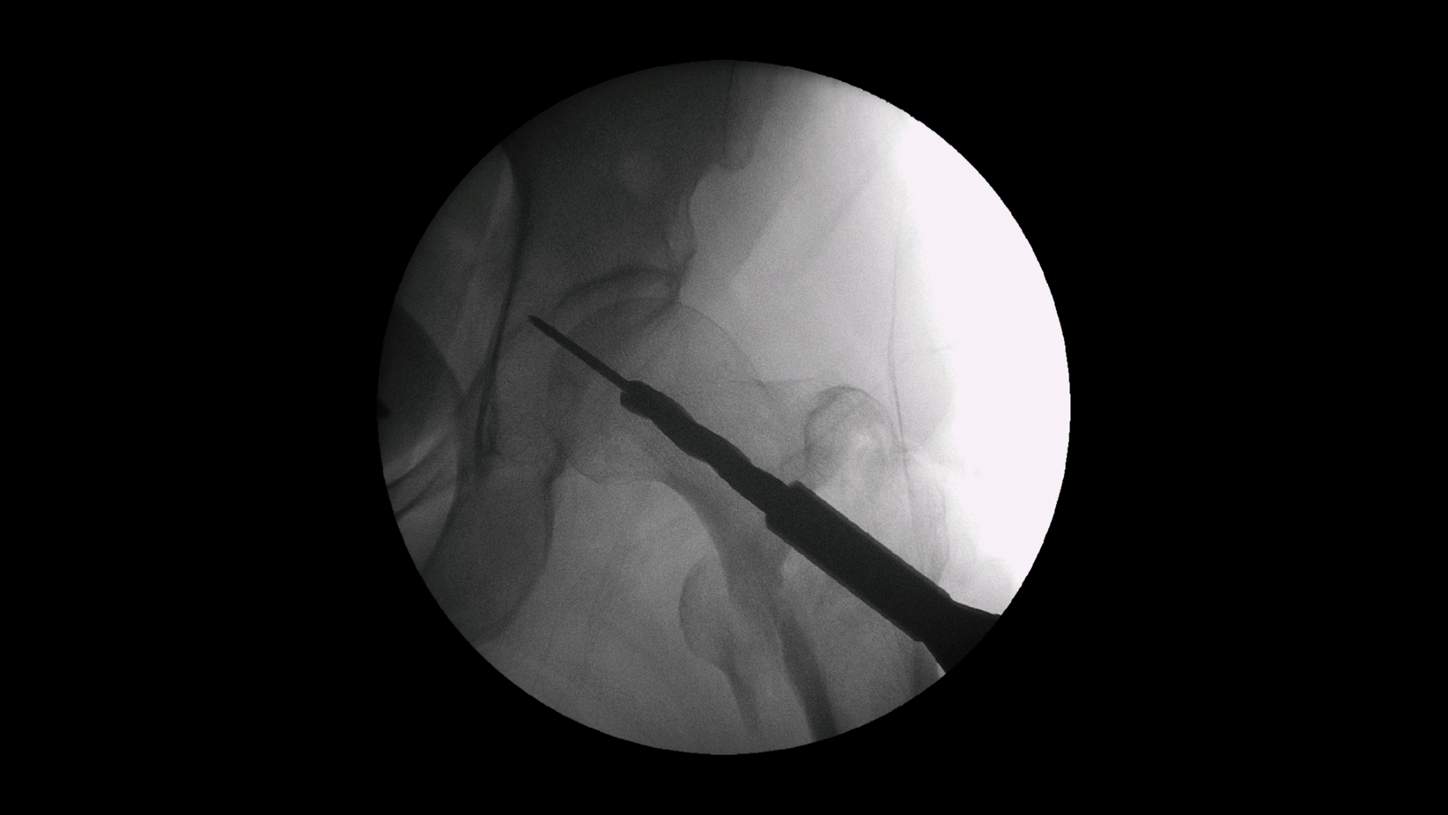 Proximal femur surgery with Cios Fit, a mobile 2D C-arm for surgery.