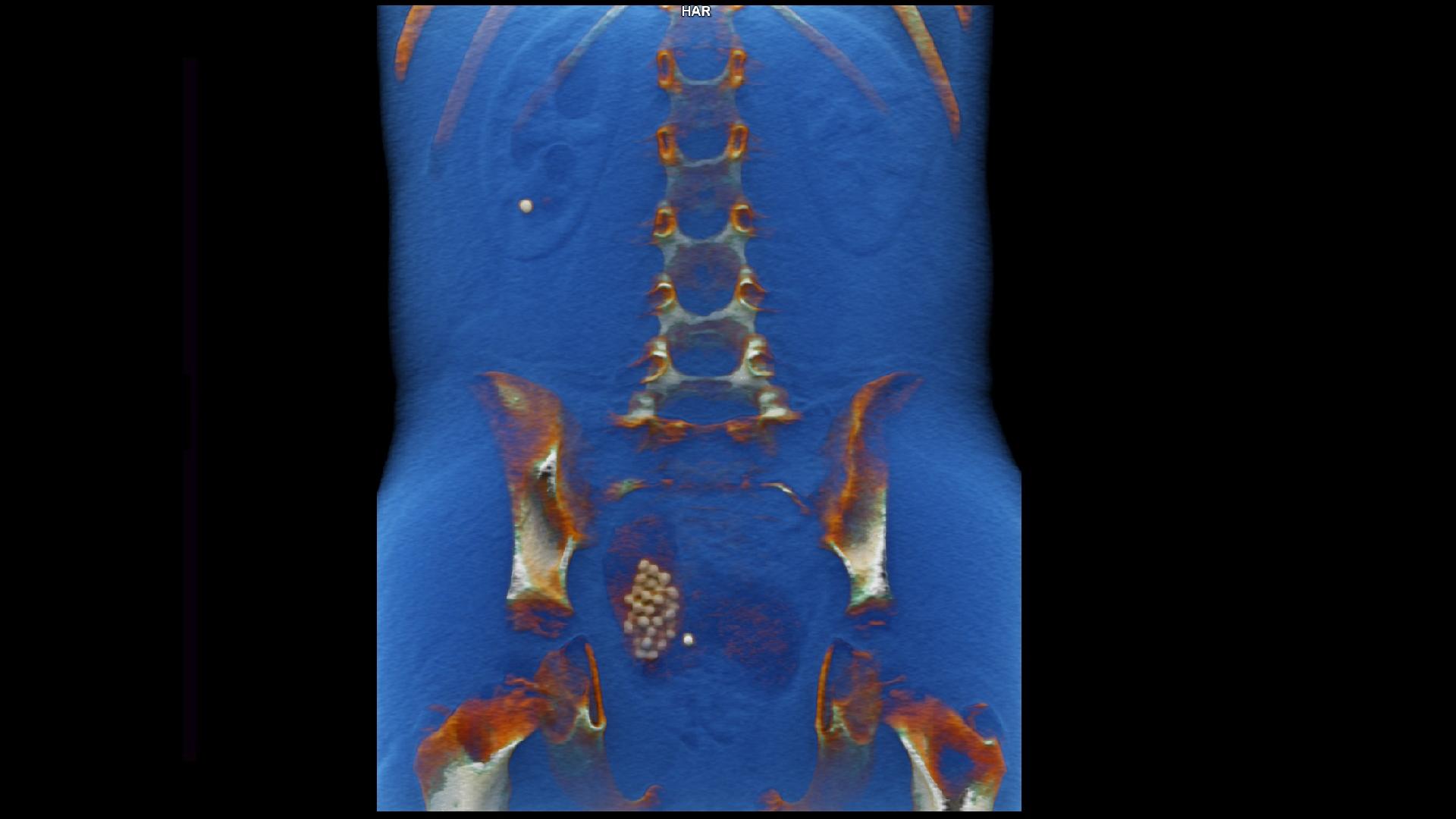 pediatric-ureterocele-complicated-by-urolithiasis-siemens