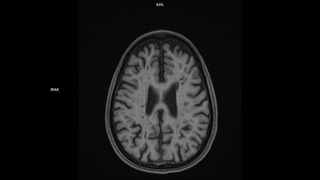 T1 MPRAGE FS AX -MAGNETOM Sola/Coil-HeadNeck 20/Resolution-512/Scan Time-3:46