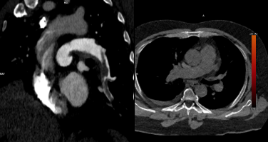lung image
