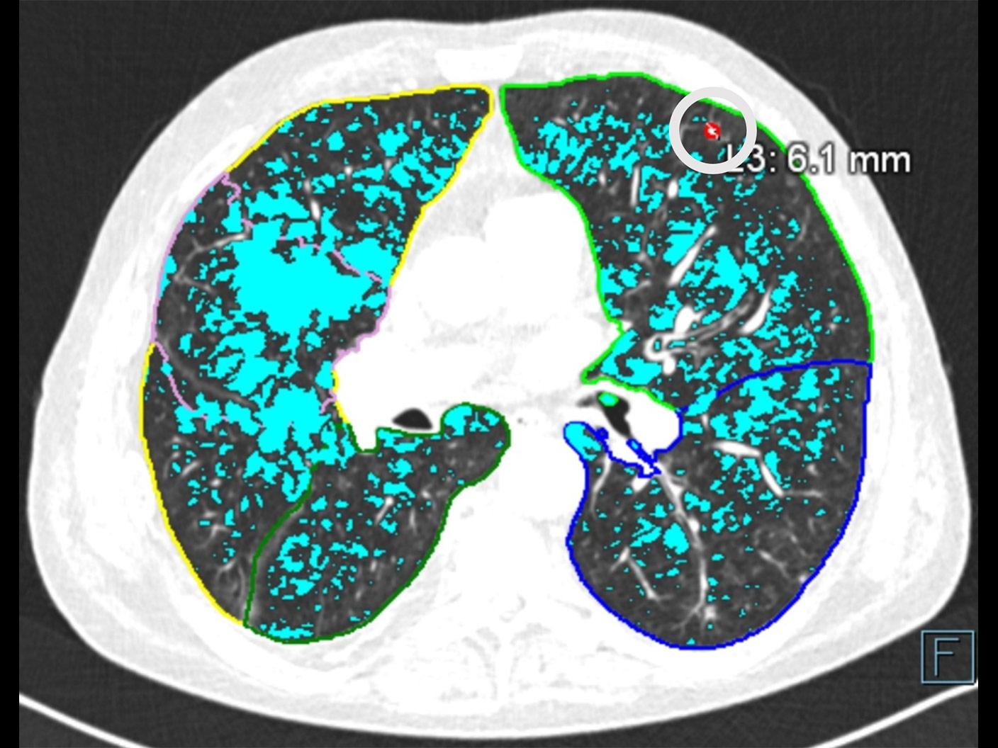 Axial lung AIRC overlay
