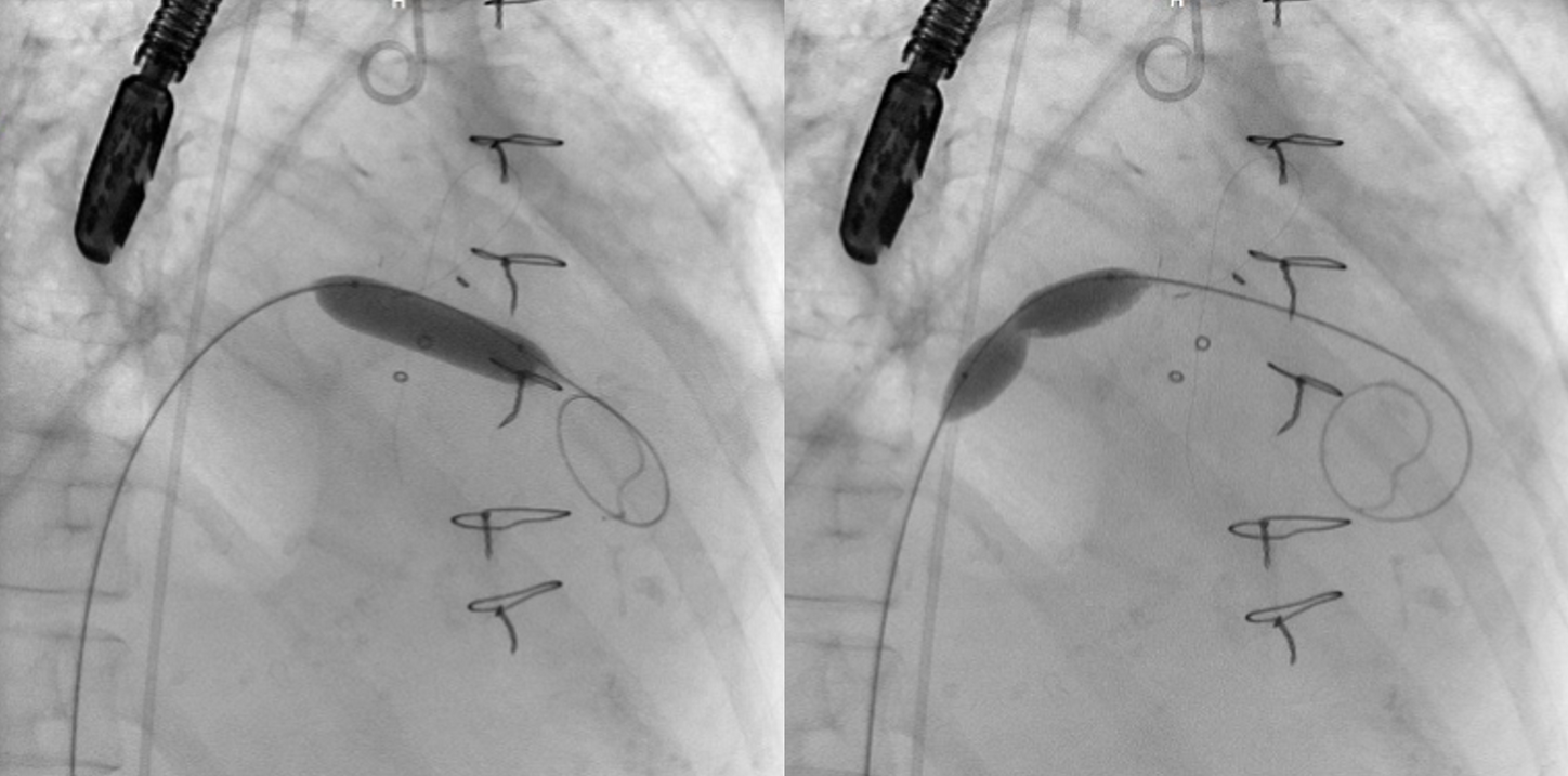 Transeptal access and valve ballooning to prepare for valve deployment.