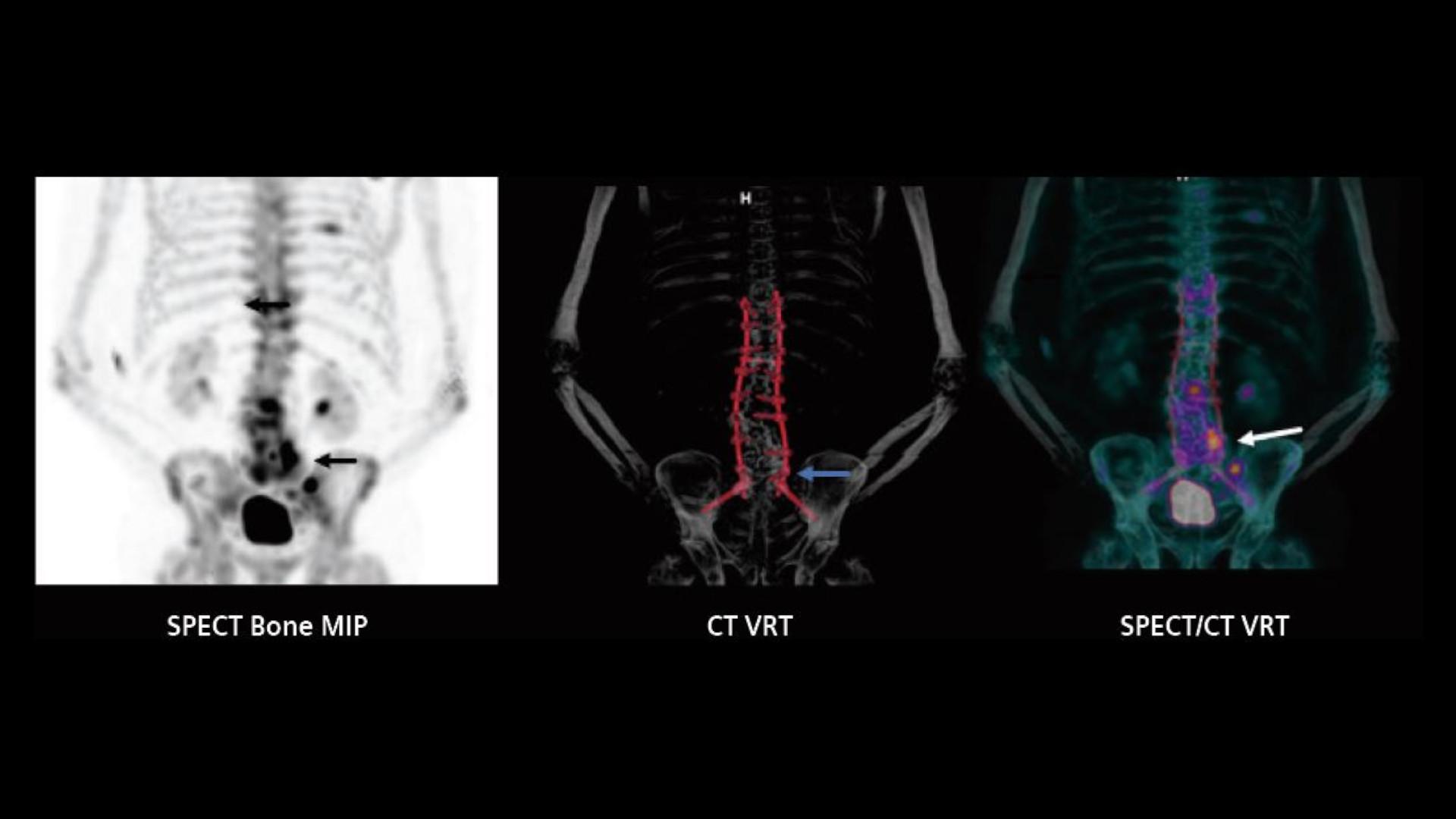 SPECT/CT imaging in the evaluation of pain following spinal fusion