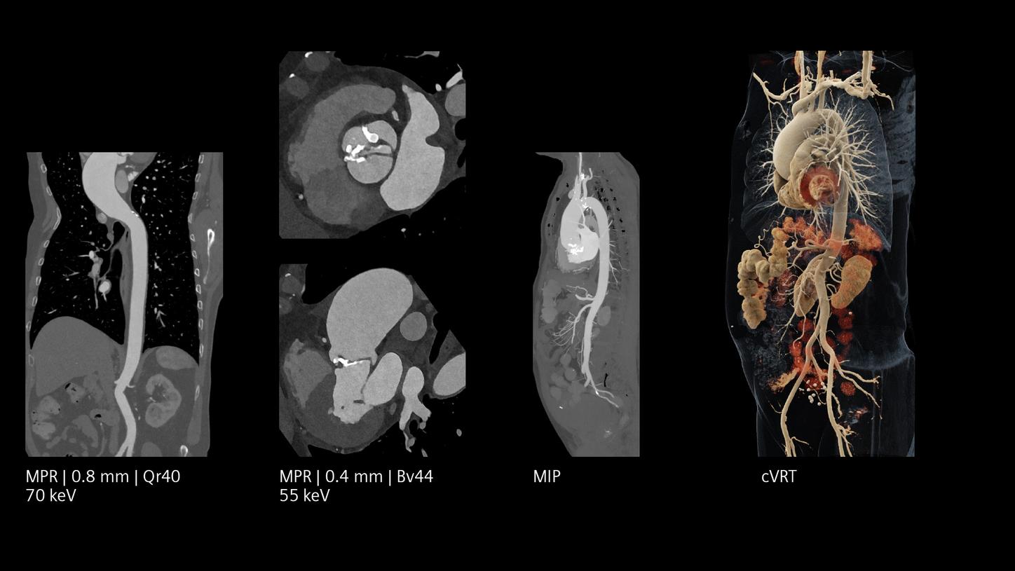 CT angiography showing detailed vascular structures and abdominal organs in cross-sections and 3D view.