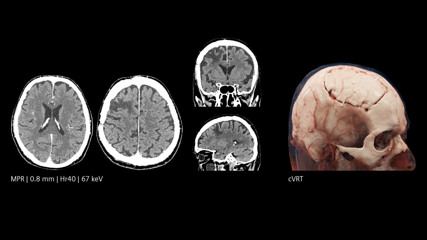 Brain CT scans with axial, coronal, sagittal views and a 3D skull rendering showing surface vessels.