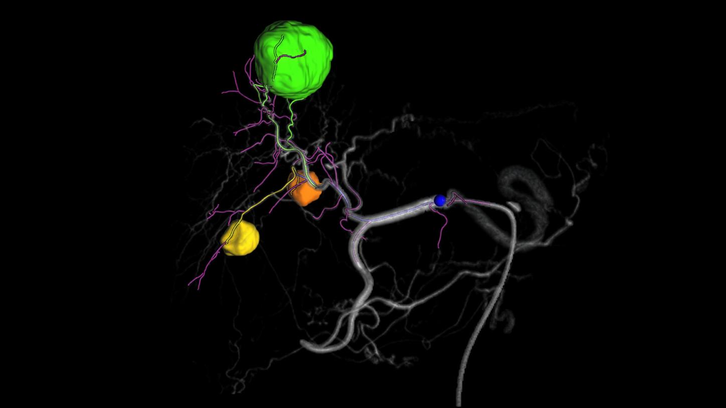 Angio for Interventional Oncology